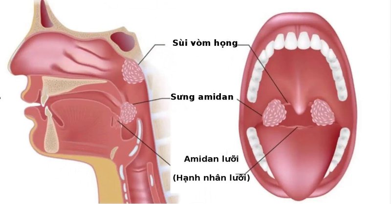 Viêm Amydal cấp tính 